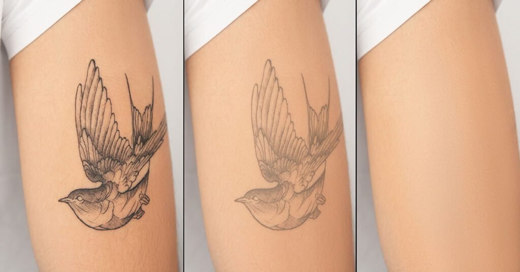 tattoo removal how long does it take
