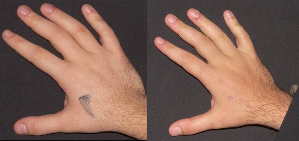 tattoo removal how long does it take
