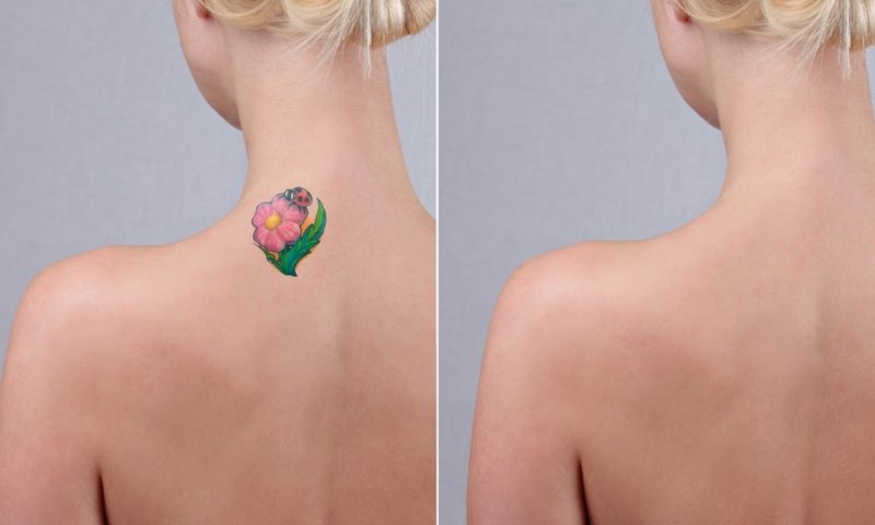 tattoo removal how long does it take