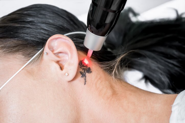 tattoo removal how long does it take