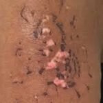 tattoo skin reactions